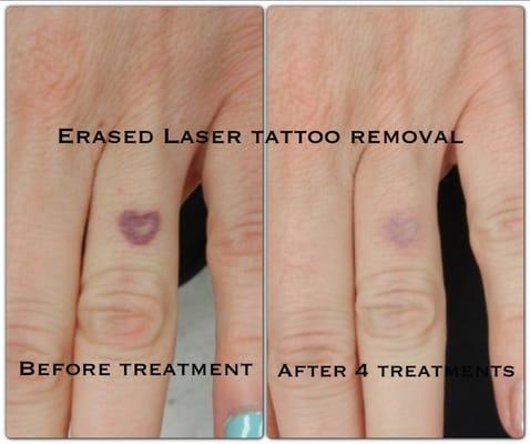 After the 4th treatment. Erased Tattoo Removal Las Vegas www.erasedlasertattooremoval.com