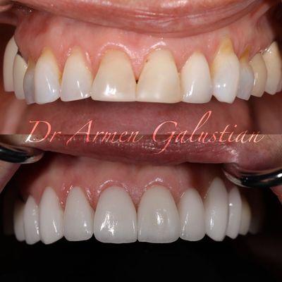 Smile makeover with 8 veneers and crowns