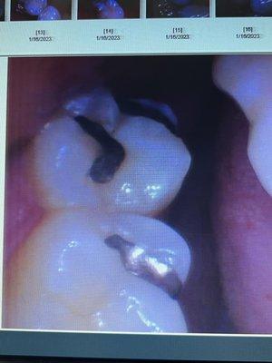 Before (my silver fillings)