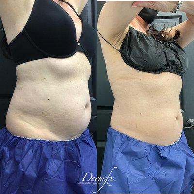 Coolsculpting