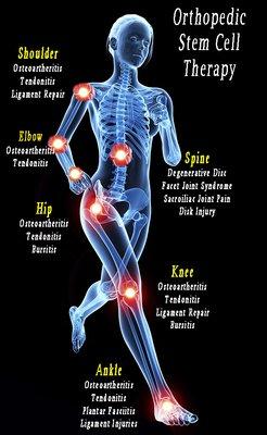 Stem Cell Therapy