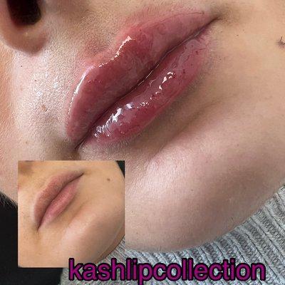 Hyaluron Pen Lip Filler