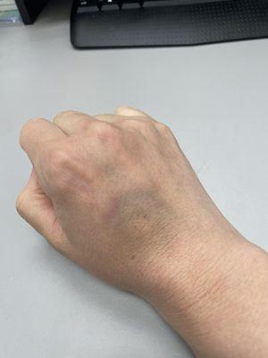 Bruising at the IV site