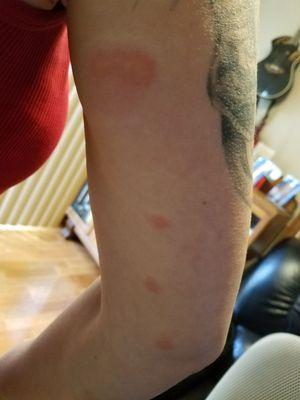 Bed Bug Bites