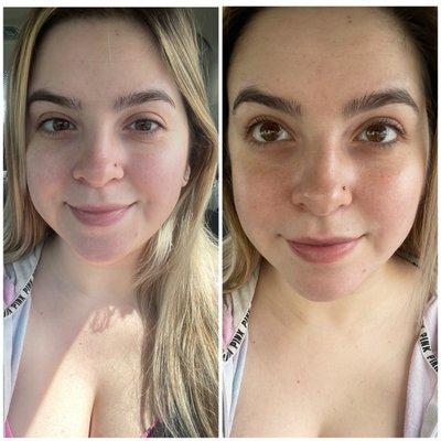 Before and after my Diamond microdermabrasion and Oxygen facial