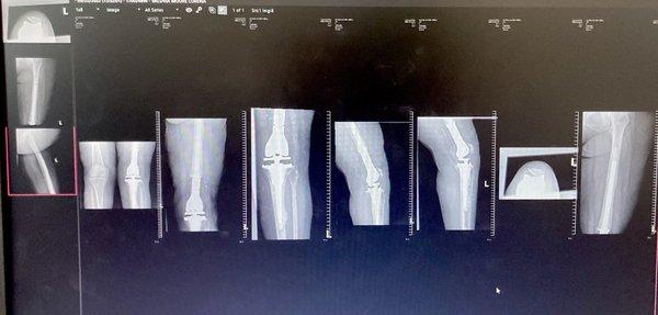 Titanium implant replacement