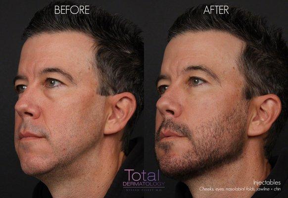 Patient was treated with filler in the cheeks, under the eyes, nasolabial folds, jawline and chin.