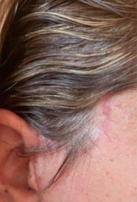 Noticeable and large scar from cheek lift, some call this procedure a mid facelift