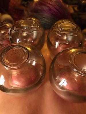 Fire cupping close up