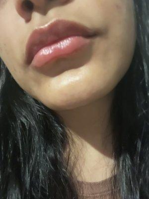 Lip fillers