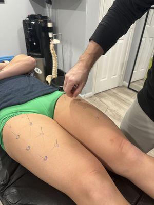 Dry needling therapy on overworked legs