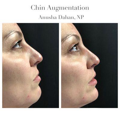 Chin projection with dermal filler for profile balance