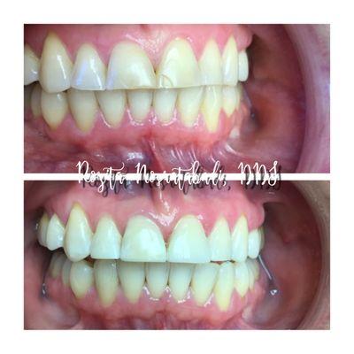 Gingival gum enhancement before & after