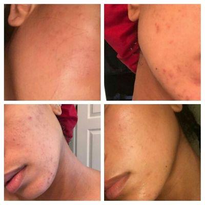 Post Acne pigmentation treatment.