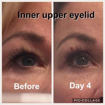 My OWN upper eyelift, no needles, no surgery. Final results at 90 days! LASTS FOR YEARS. Specials on FB page plus lots of before and afters.