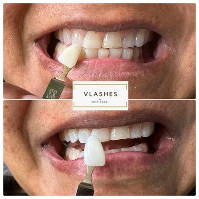 Teeth whitening treatment