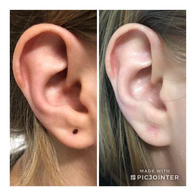 Before and After of ear repair performed by PA Lambert.