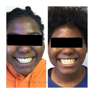 Orthodontic braces and teeth whitening before & after