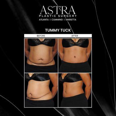 A tummy tuck, also known as abdominoplasty, strengthens weakened abdominal muscles and improves the appearance of loose abdominal skin.