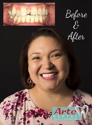 Great before and after of an Invisalign case.