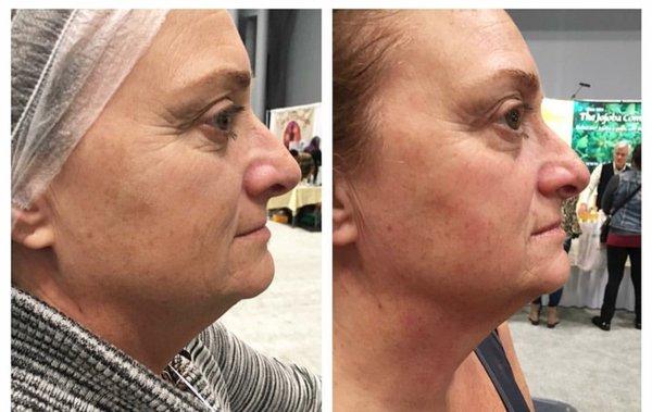 pure sculpt facial