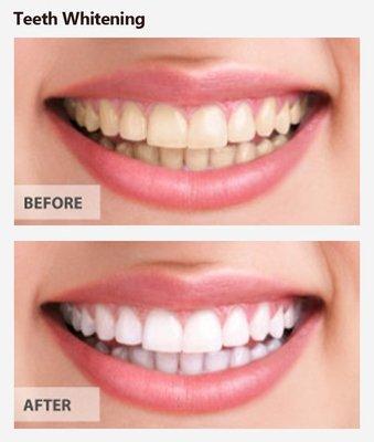 Zoom teeth whitening