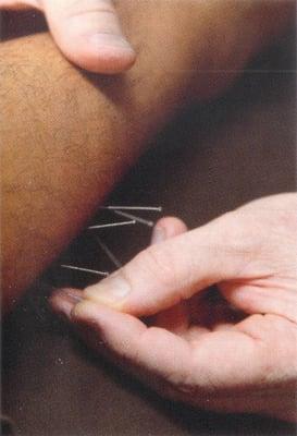 Acupuncture Treatment