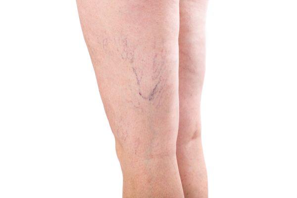 Spider Veins