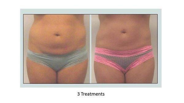 3 treatments after Ultraslim treatment using Photonica device