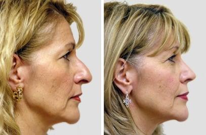 Rhinoplasty