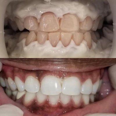 Whitening (Zoom)