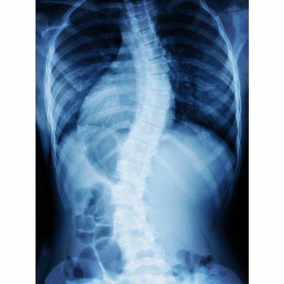 X-ray demonstration of scoliosis