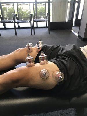 Myofascial decompression cupping for recovery.