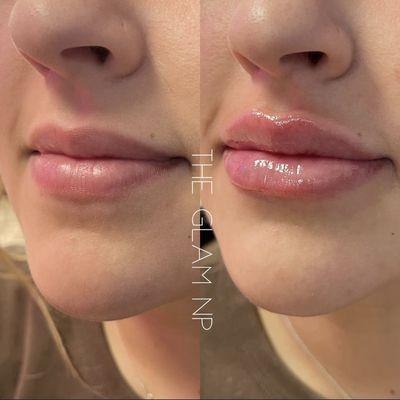 Before & After Lip Filler