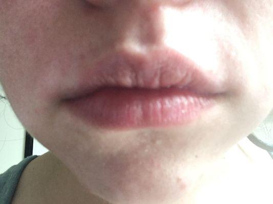 Lips were swollen after getting my upper lip threaded. Threading was rough and more painful than it should have been.