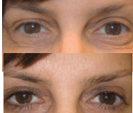 Before and After! 49-Year-Old Female
 Upper & Lower Eyelid Procedures