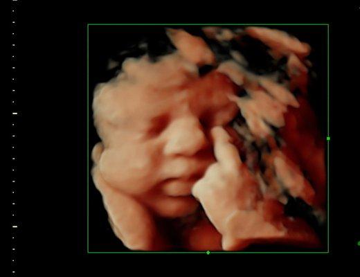 Fetus with attitude giving the middle finger in a SonoSmile 3D/4D HDlive ultrasound.