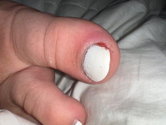 gross, i know. but here is one of my infected toes.