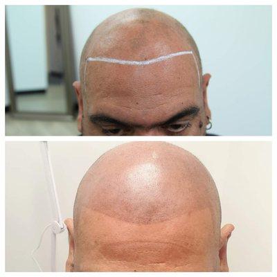 Scalp Micropigmentation Density fill before and second session