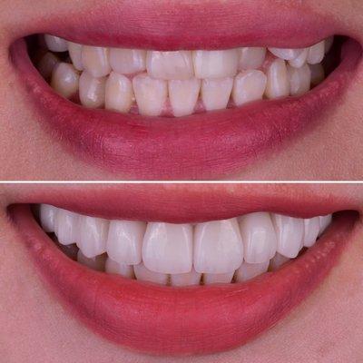 Instant orthodontics with porcelain veneers for this patient