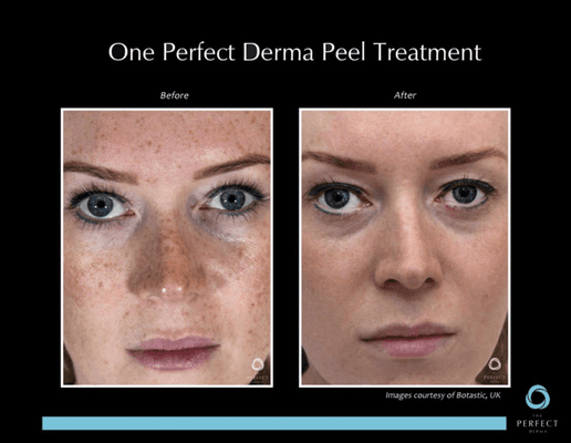 The Perfect Derma peel before and afters!