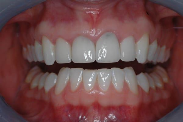 Patient had these veneers done 3 times prior to coming to my practice!