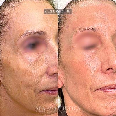 CO2 Laser Lite Results! Brown spots gone, and skin is tighter, lifted, and healthier. She was happy and said the downtime was worth it!