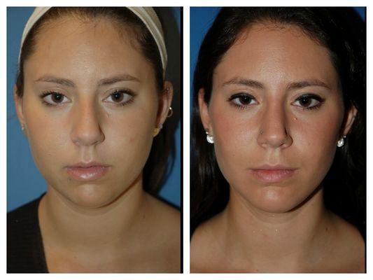 Rhinoplasty patient by Dr William Portuese