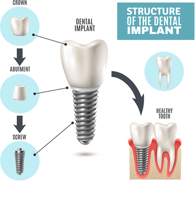 Dental Implants + Abutment + Crown for Only $2500