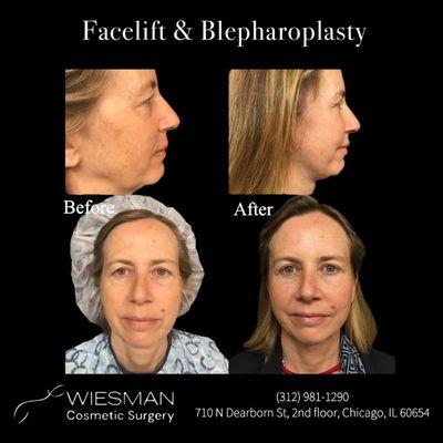 Facelift and Blepharoplasty by Dr. Irvin Wiesman. Please call (312)981-1290 to schedule your appointment!