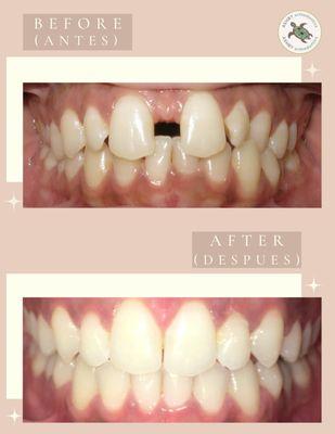 Smile Metamorphosis! Metamorfosis de la Sonrisa!