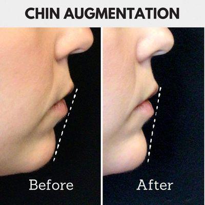 Chin Augmentation - a little filler goes a long way to add volume for a lovely contour.