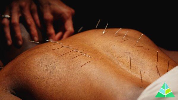 Acupuncture for back pain