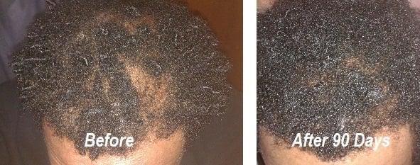 After only 90 days, this client saw substantial hair regrowth.